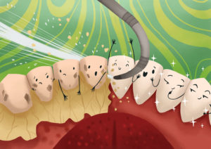 detartrasi - ablazione tartaro - pulizia dentale