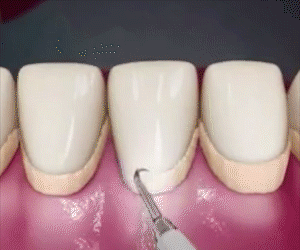 video pulizia dei denti