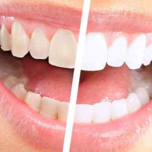 sbiancamento denti roma