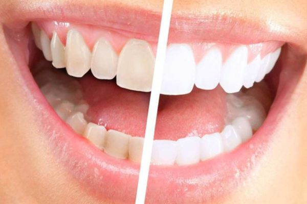sbiancamento denti roma