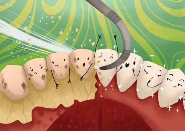 Ablazione tartaro - Detartrasi - Pulizia dei denti