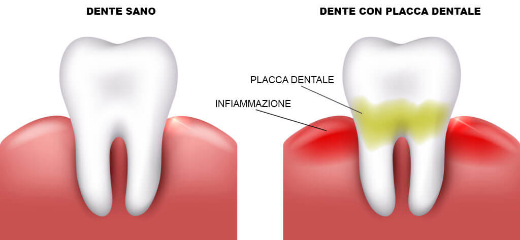 dente sano e con placca dentale e tartaro