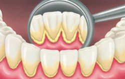 placca dentale - Tartaro sui Denti