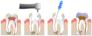Devitalizzazione - Cura Canalare - Endodonzia