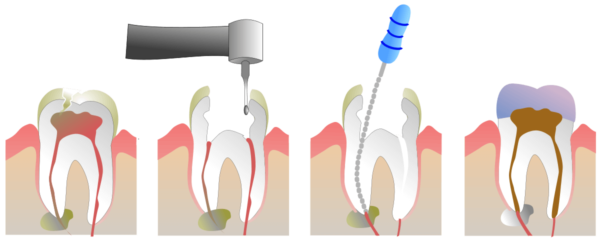 Devitalizzazione - Cura Canalare - Endodonzia