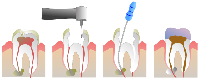 Devitalizzazione - Cura Canalare - Endodonzia