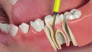 Devitalizzazione dente - Cura Canalare