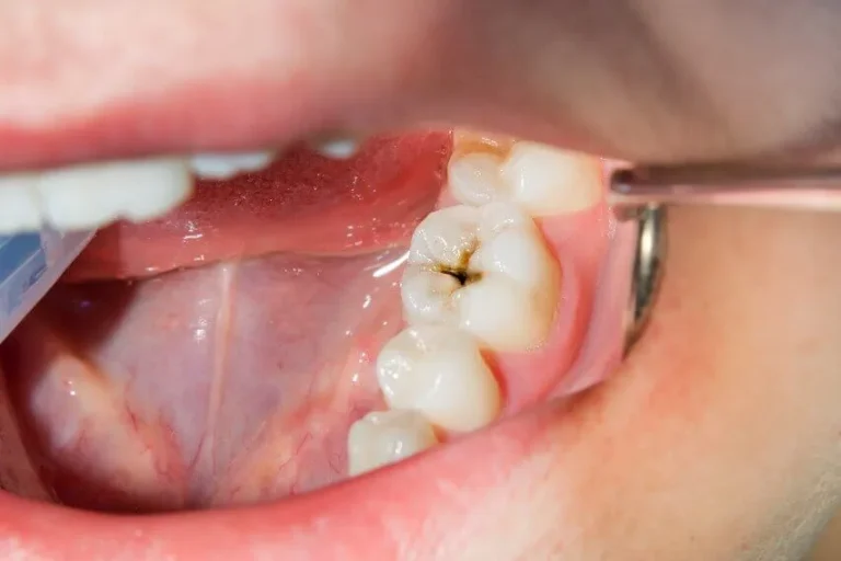 Carie Dentale - Carie sui Denti