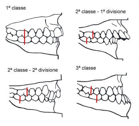 Classi di Malocclusione Dentale