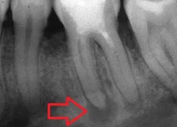 granuloma dentale - ortopantomografia radiografia