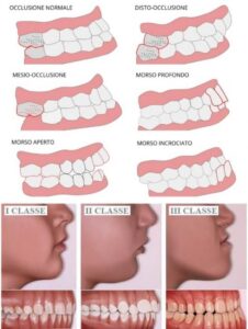 Malocclusione Dentale - Diverse Classi - Tipi di malocclusione