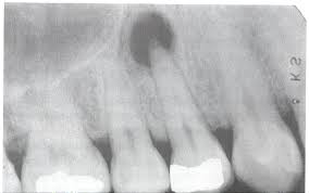Ortopanoramica Granuloma Dentale