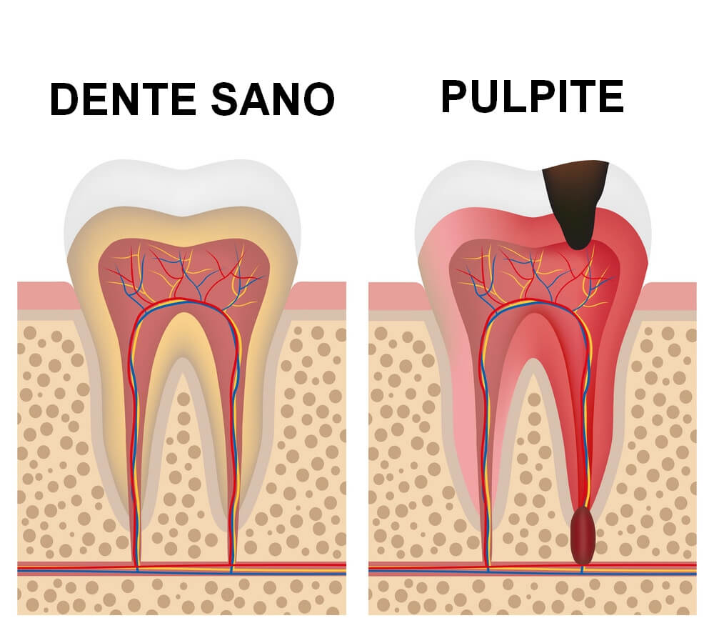 Bloccare Dente Che Si Muove Pulpite Dentale - Cos'è, Cause e Come Curarla - Studio Biodental