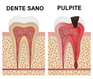 Pulpite-Dentale-Mal-di-Denti-Dente-che-Pulsa