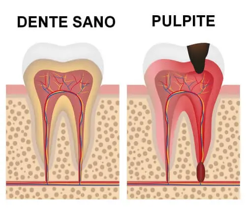 Pulpite Dentale - Mal di Denti - Cura Sintomi