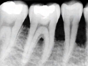 Radiografia Tasche Gengivali