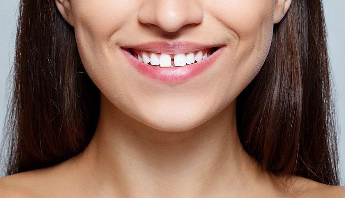 Sorriso con Diastema Dentale - Diastema Denti