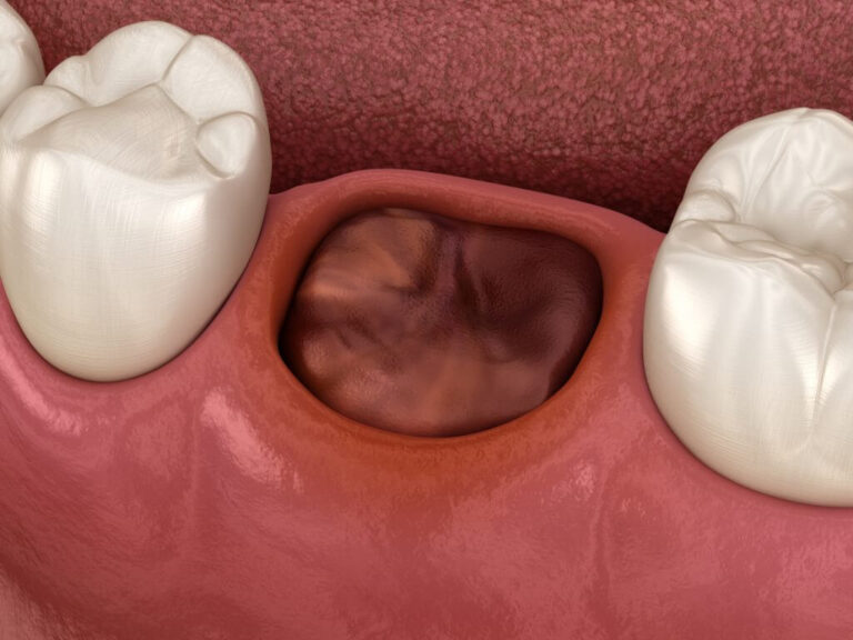 alveolite dentale post estrazione dente