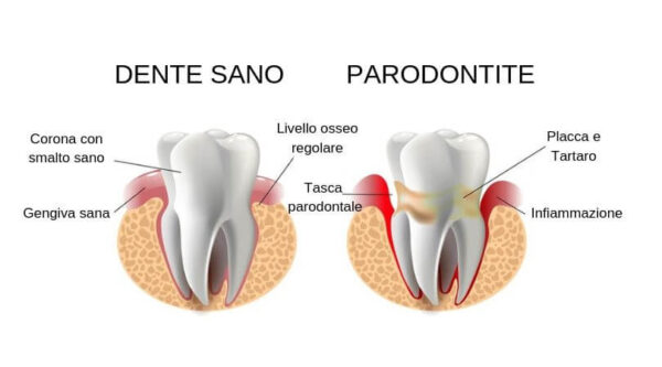 Differenza gengiva sana e parodontite - piorrea - tasche gengivali