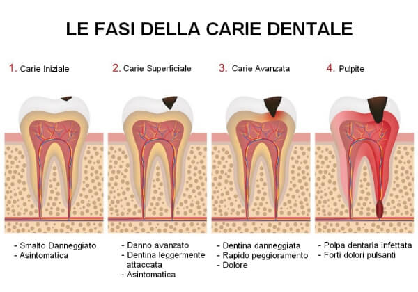 fasi della carie dentale