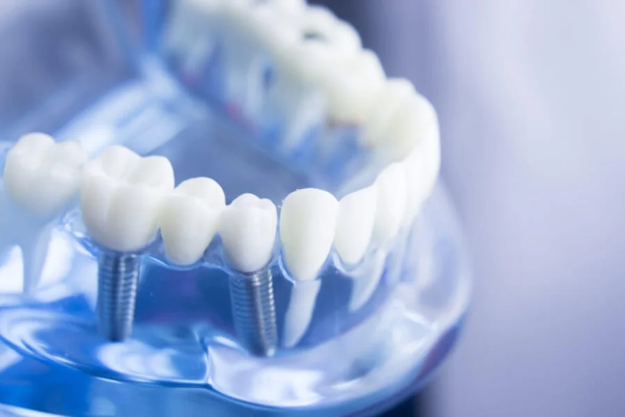 Impianto dentale Roma Straumann - Impianti Dentali Roma