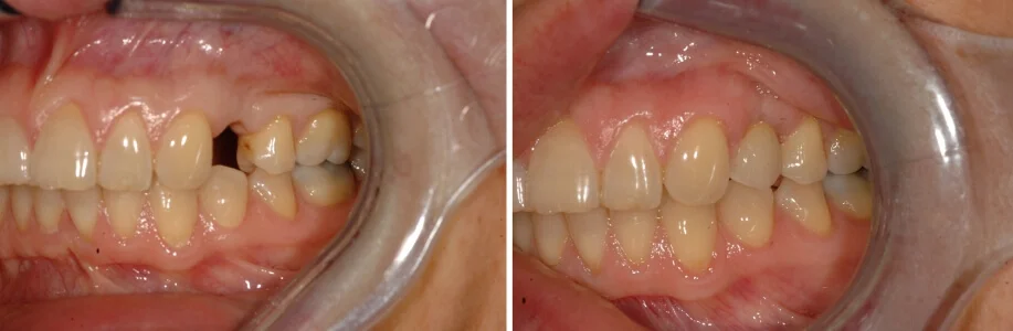 Impianti Dentali - Prima e Dopo
