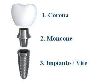 impianto dentale - corona moncone vite