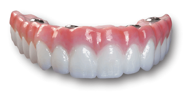 Implantologia a Carico Immediato - Protesi Provvisoria Totale Toronto Bridge - Impianto Dentale Carico Immediato - Dentiera Fissa