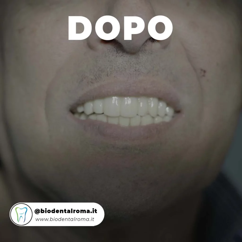 Impianto Dentale Roma - Prima e Dopo 2