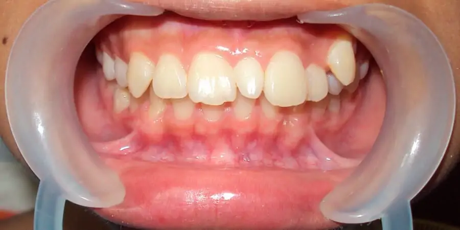 Affollamento Dentale - Ortodonzia per Bambini - Ortodontista Pediatrico