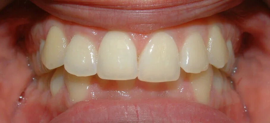 Morso Profondo - Ortodonzia Pediatrica - Ortodontista Pediatrico