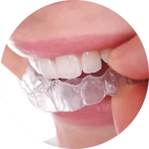 Ortodonzia Invisibile - Apparecchio Trasparente - Apparecchio Denti Invisibile