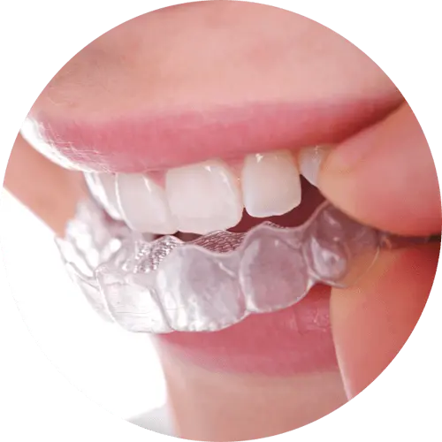 Ortodonzia Invisibile - Apparecchio Trasparente - Apparecchio Denti Invisibile