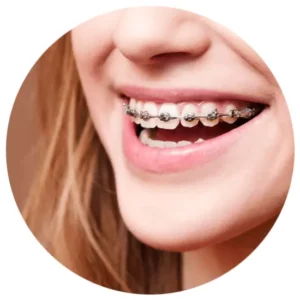 Apparecchio Denti Fisso - Ortodonzia Fissa