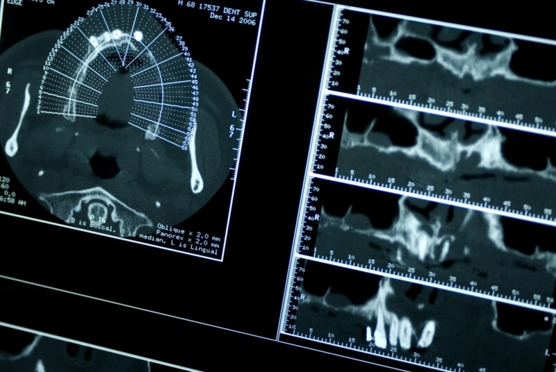 Implantologia Avanzata - Chirurgia Computer Guidata