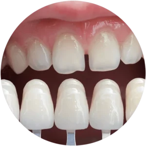 Faccette Dentali Rovinano i Denti?