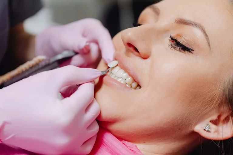 Faccette Dentali Costi Prezzi