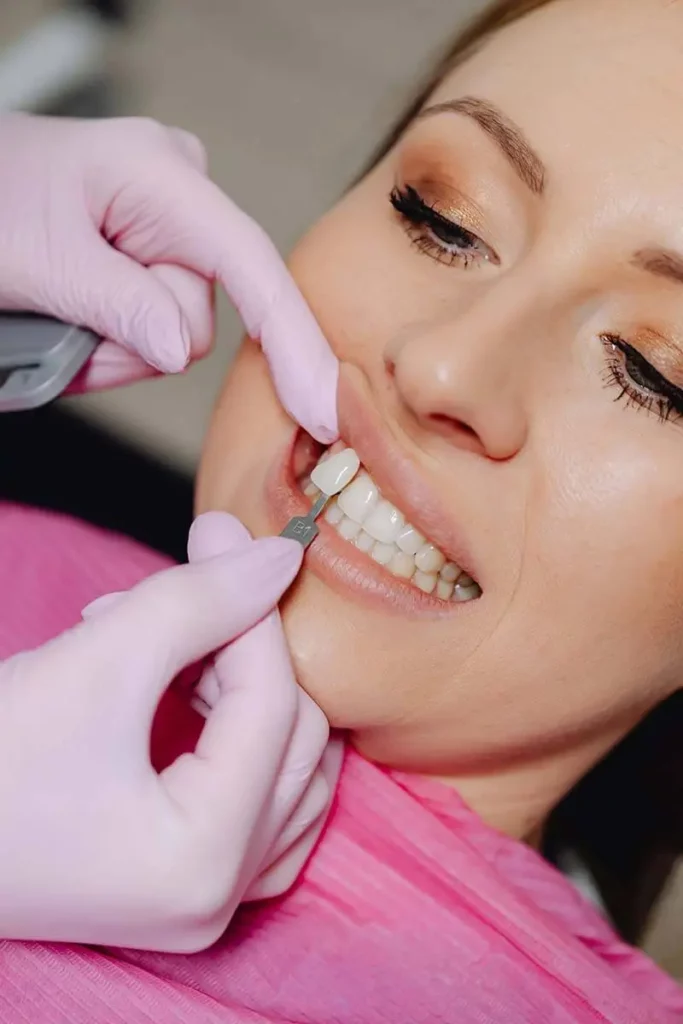 Faccette Dentali Estetiche Denti Bianchi - Cosa Sono