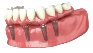Impianti Dentali All on Four - Implantologia All on 4