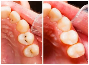 Otturazione Denti Roma Biodental