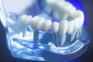 Impianto Dentale Roma