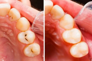 Otturazione Denti - Dentista Roma