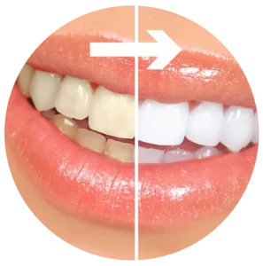 Sbiancamento dei Denti Roma - Sbiancamento Dentale