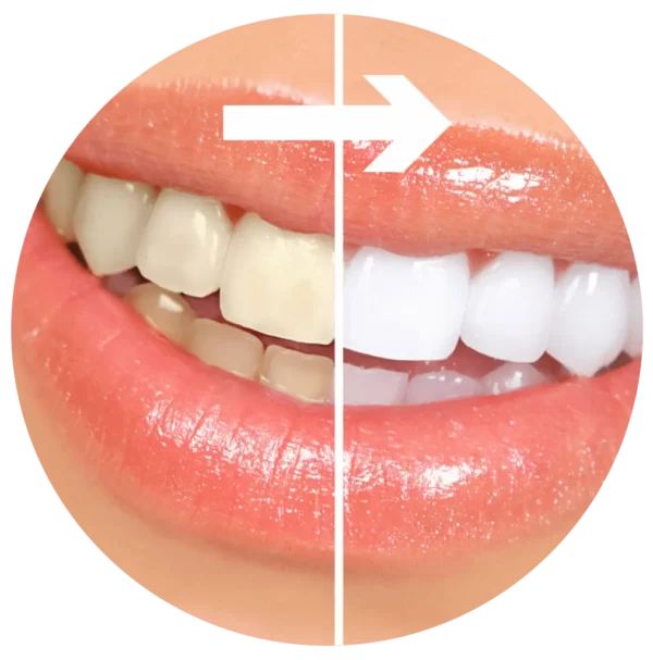 Sbiancamento dei Denti Roma - Sbiancamento Dentale