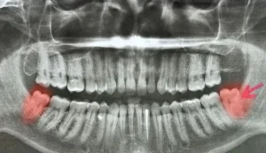Estrazione Denti del Giudizio
