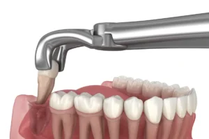 Estrazione dente del giudizio