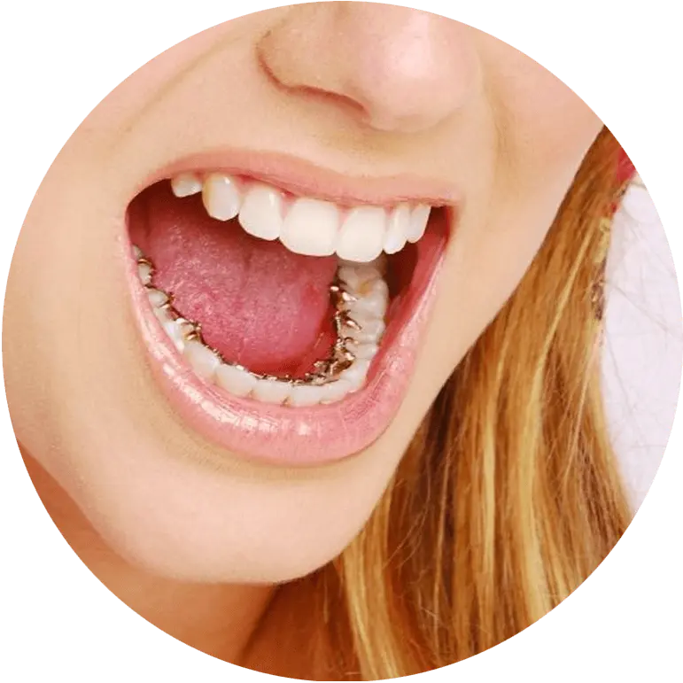 Apparecchio Denti Invisibile - Apparecchio Invisibile - Apparecchio Linguale