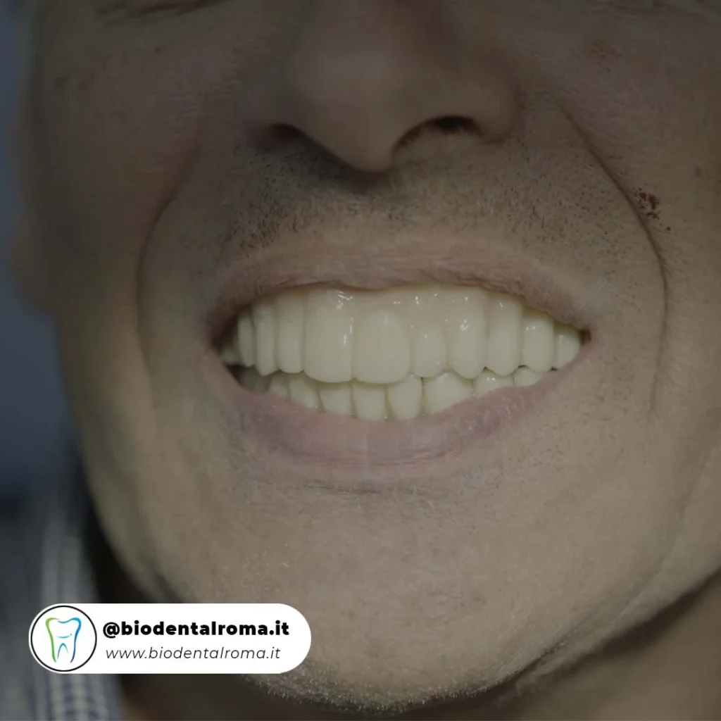 Soluzioni economiche per denti mancanti alternative