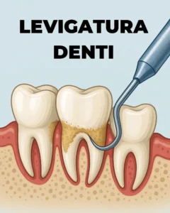 Levigatura Denti - Levigatura Radicolare