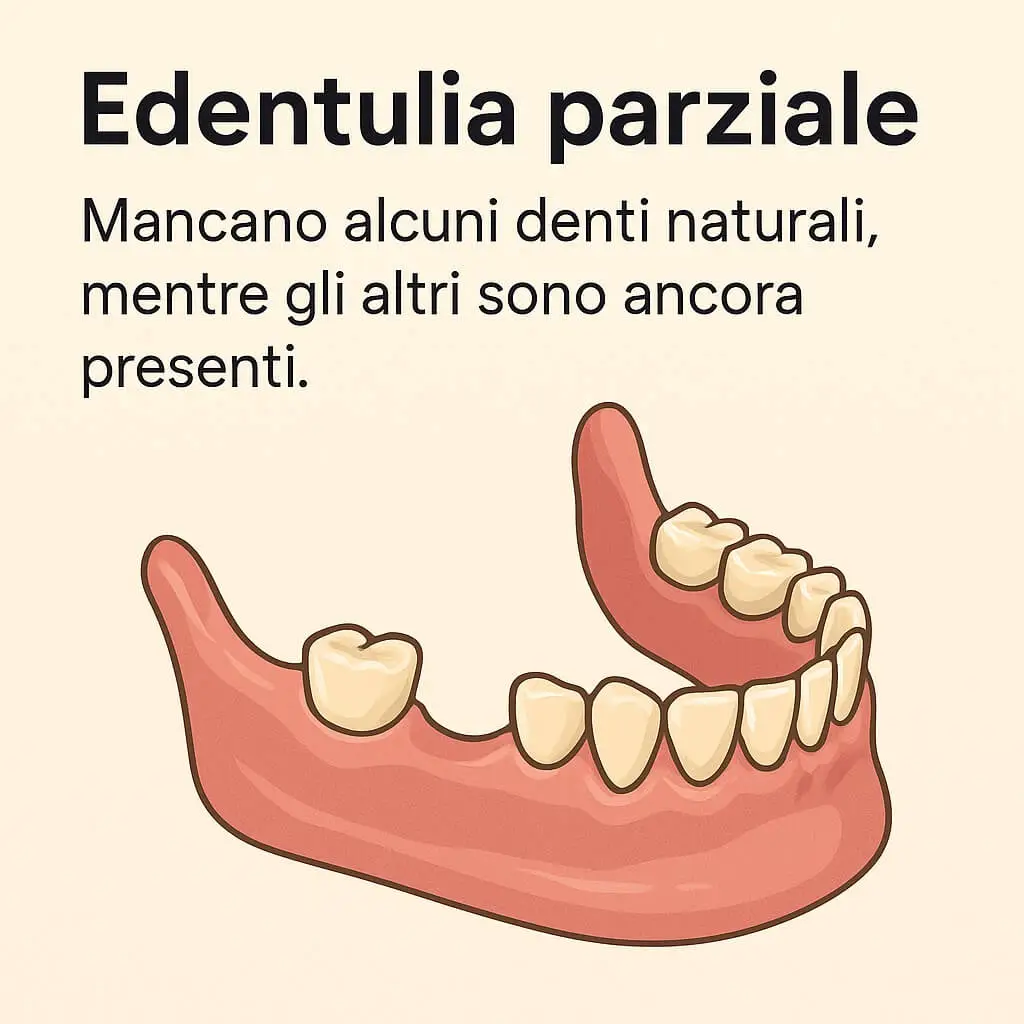 Edentulia Parziale